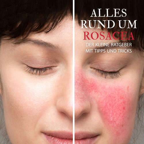Hoerbuch Alles Rund um Rosacea - Der kleine Ratgeber mit Tipps und Tricks - Raphael Kleine-Termeer - Raphael Kleine-Termeer